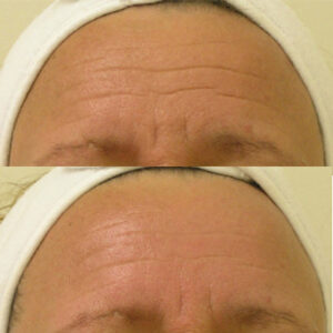 Stirnfalten vor und nach einer Behandlung