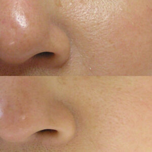Poren Hautbild vor und nach einer Behandlung